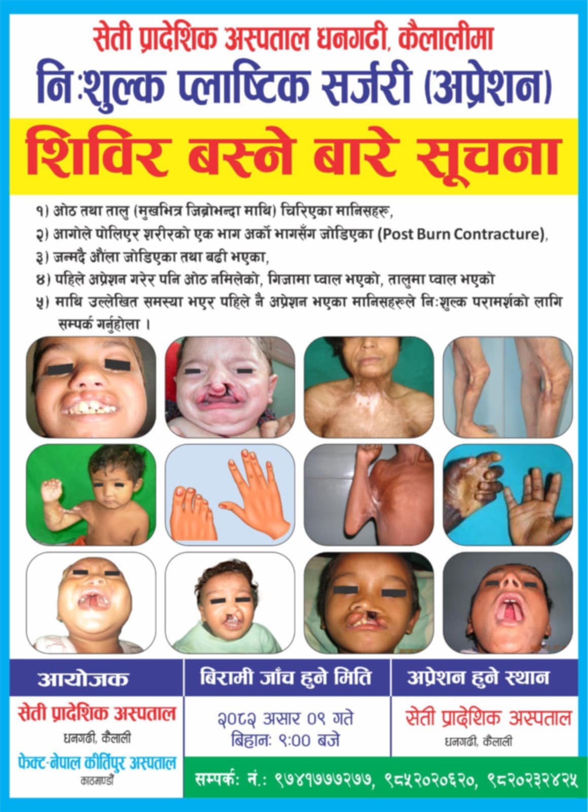 सेती प्रादेशिक अस्पताल धनगढीमा निःशुल्क प्लास्टिक सर्जरी शिविर सञ्चालन हुने